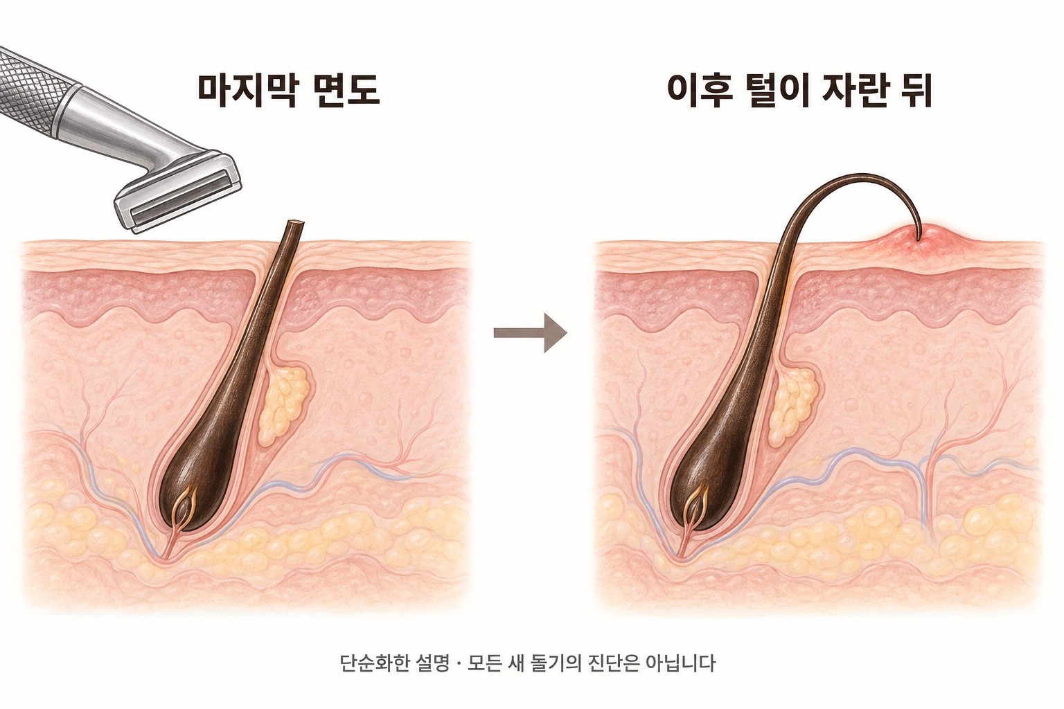 마지막 면도로 짧아진 털이 이후 자라 피부 밖에서 굽은 뒤 끝이 인접 피부로 다시 들어가 돌기가 생길 수 있는 두 시점의 단면 설명